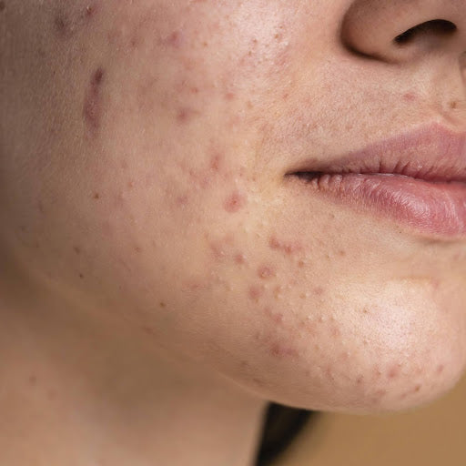 What Are Ice Pick Acne Scars and How Can You Treat Them?