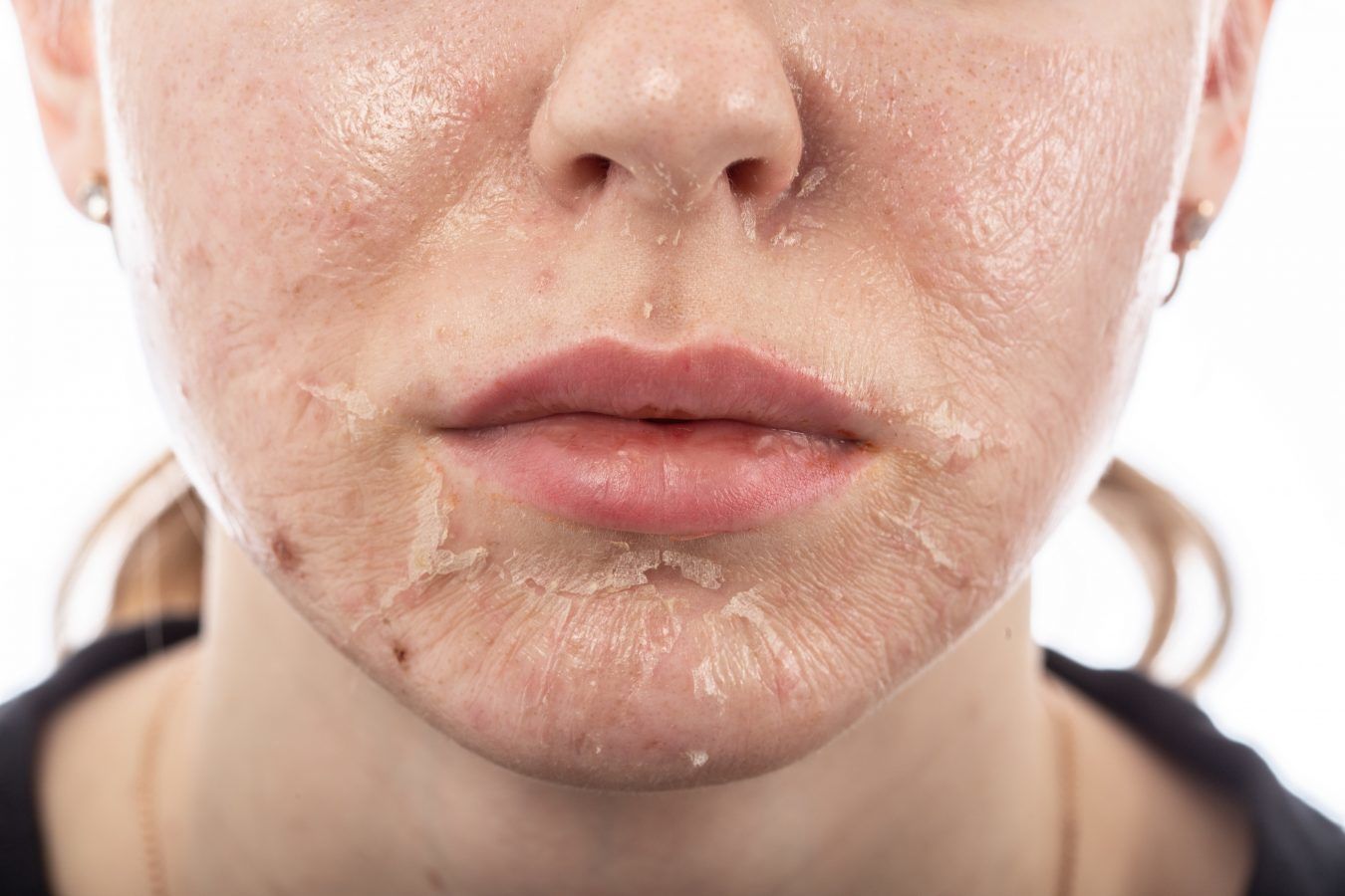 Why is exfoliation better than face peeling procedures for sensitive skin?