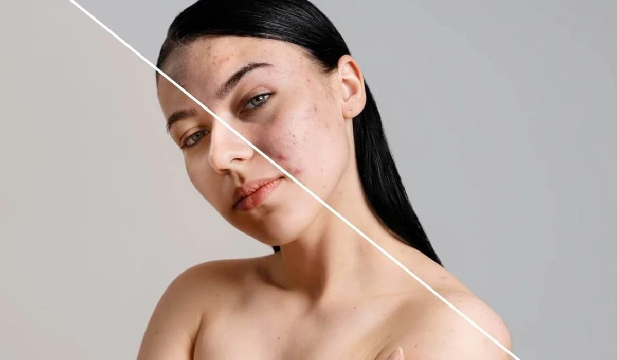 Natural Botox: Cactus Extract Benefits For Skin